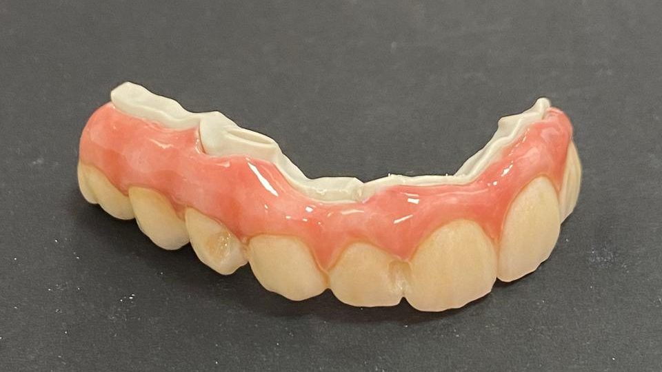 Prótesis híbrida — Prótesis híbrida: rehabilitación completa sobre implantes