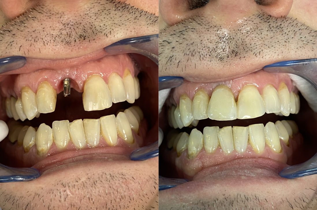 Implantes dentales — Implante dental en zona estética: antes y después