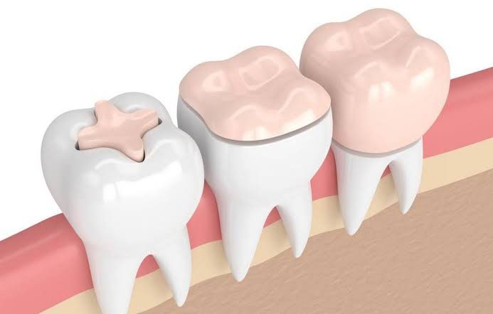 Incrustaciones en Odontología Dreyer
