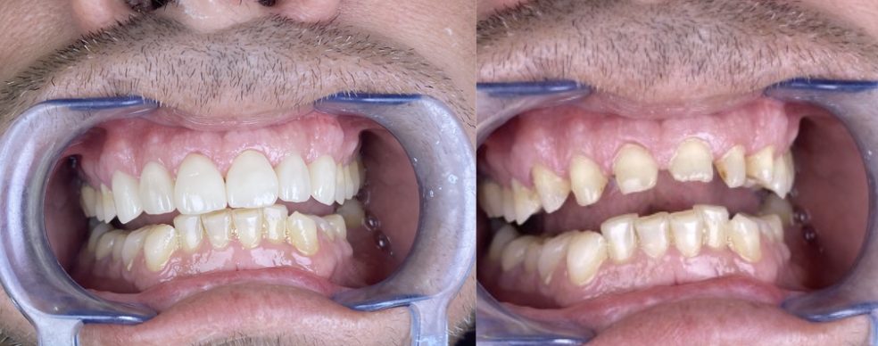 Carillas — Carillas de porcelana: transformación completa