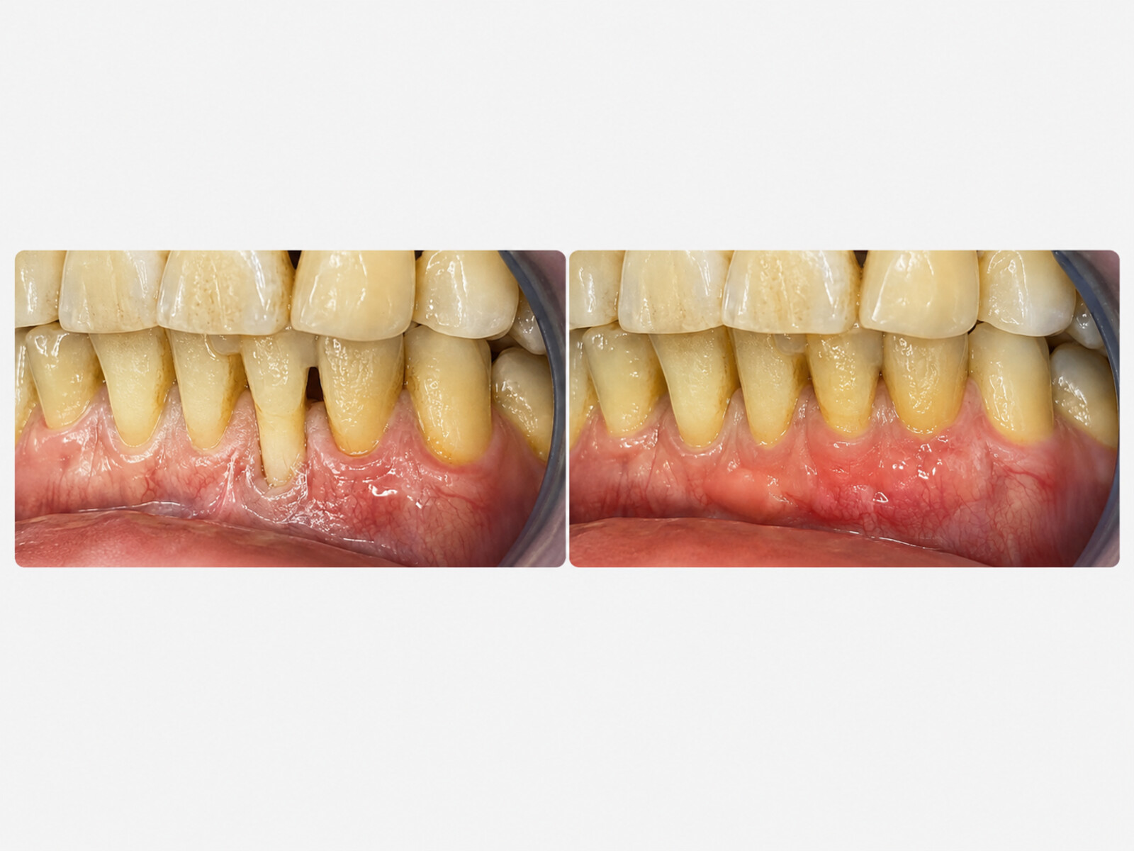 Injertos de tejido conectivo — Injerto de tejido conectivo: de raíces expuestas y encía retraída a un contorno gingival parejo y saludable