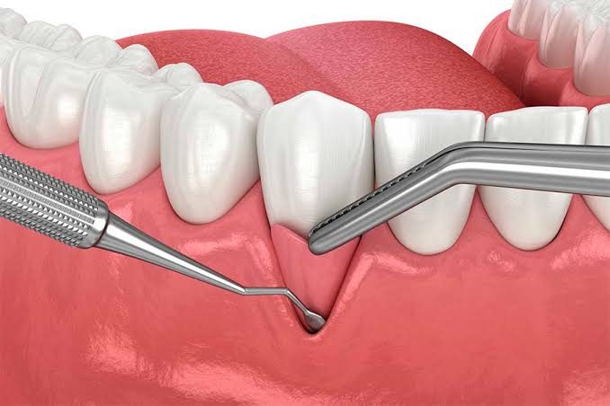 Injertos de tejido conectivo en Odontología Dreyer