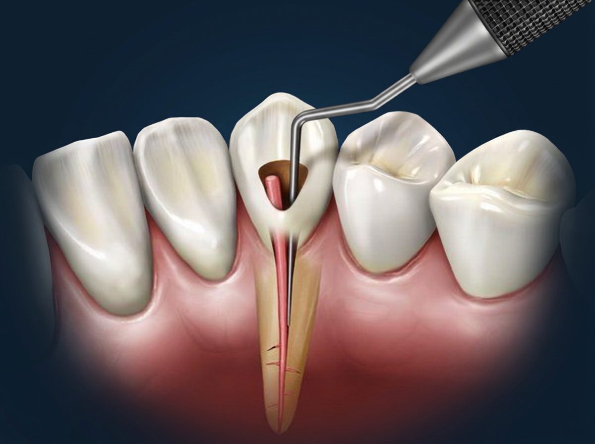 Endodoncia en Odontología Dreyer