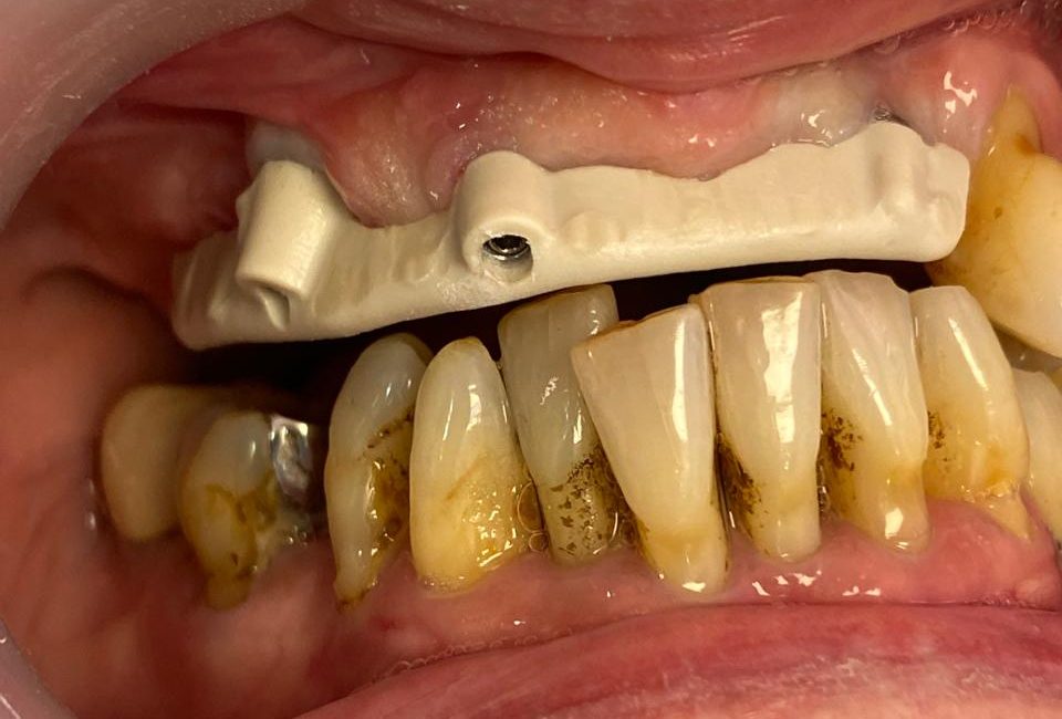 Prótesis híbrida — Prótesis híbrida: rehabilitación completa sobre implantes
