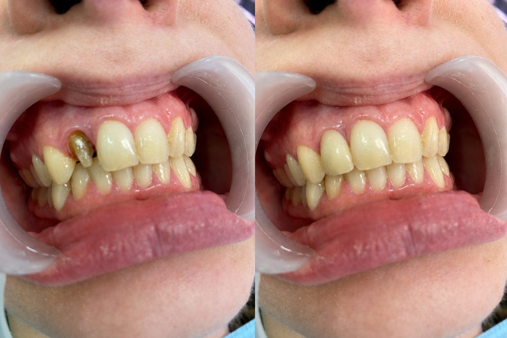 Implantes dentales — Implante dental: reemplazo de pieza dañada